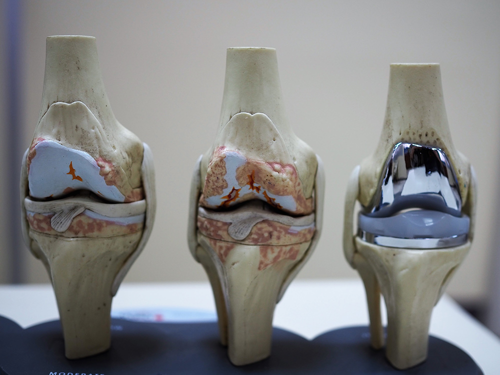 Expert knee care and replacement in San Antonio